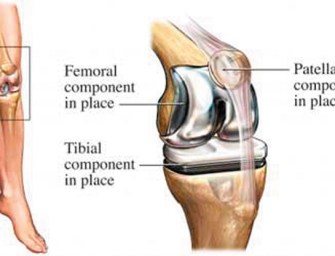 Prepping For Knee Replacement